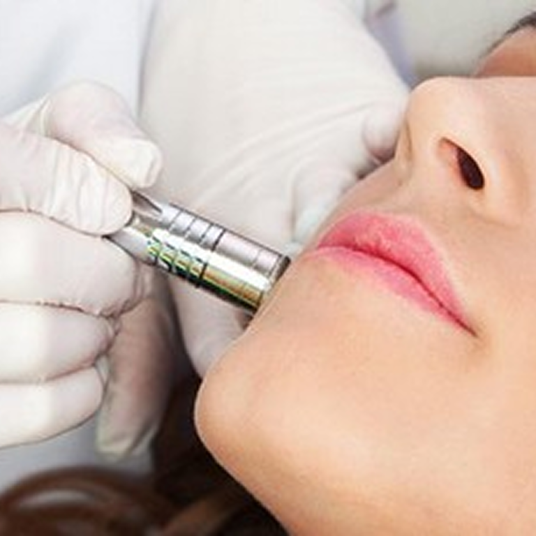 Microdermabrasion voorburg elena